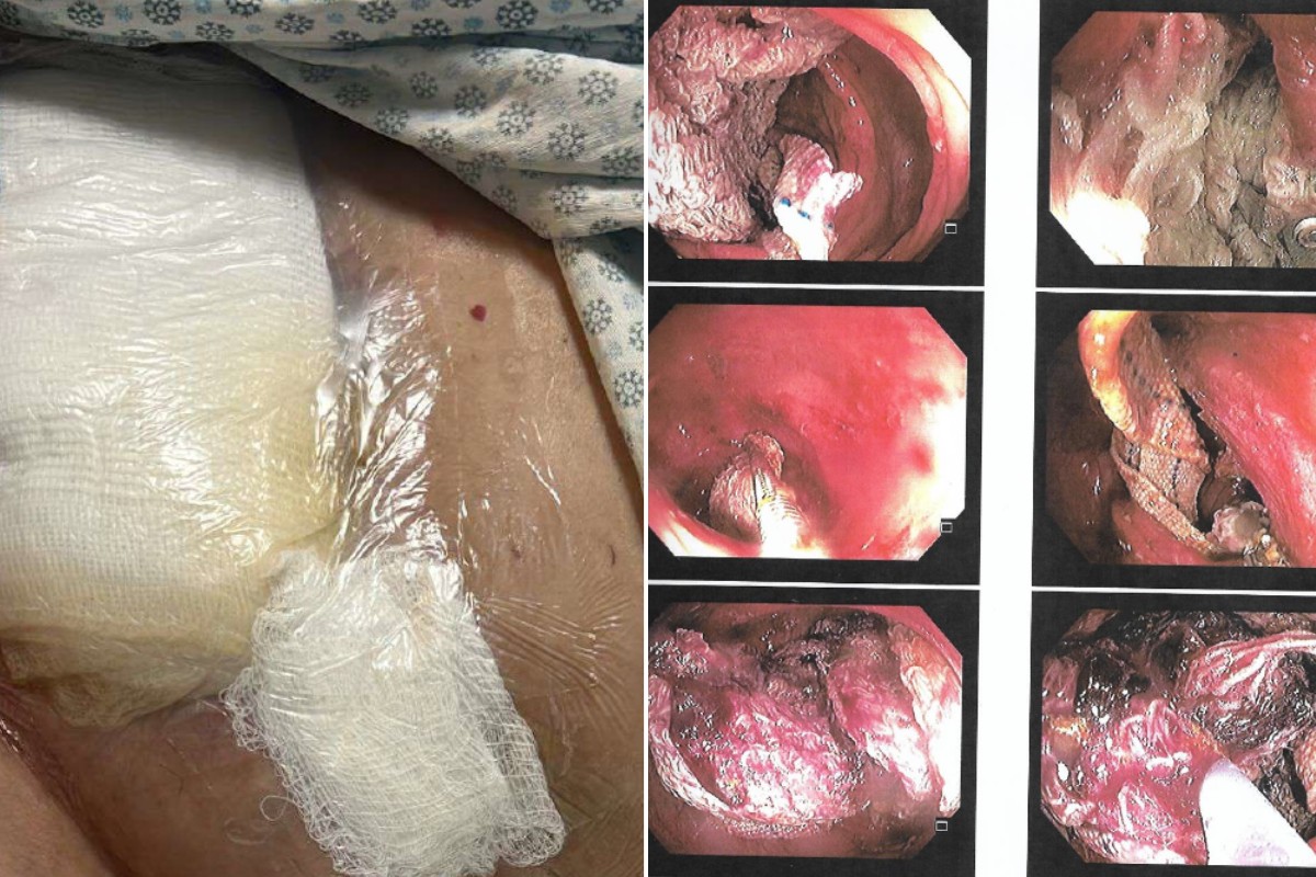 Idosa tem sequelas após gaze esquecida em cirurgia