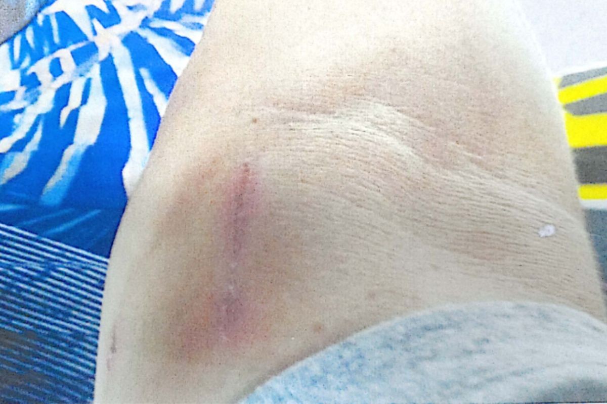 Justiça nega indenização a servidor agredido com enxada por colega