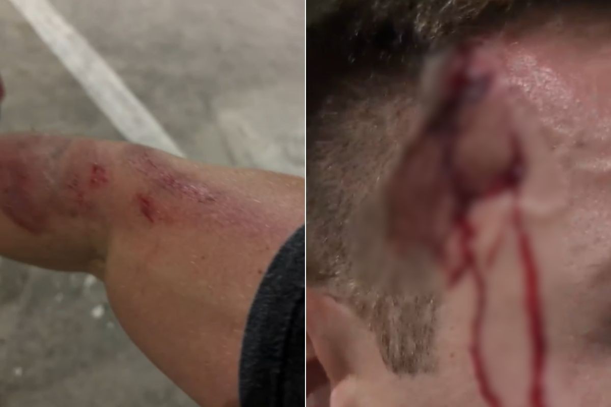 Guarda-vidas fica ferido após ser assaltado por ladrões de bicicleta
