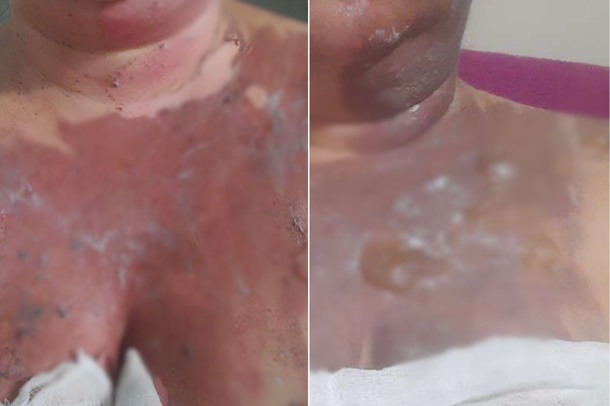 Merendeira sofre queimaduras após panela de pressão explodir em escola