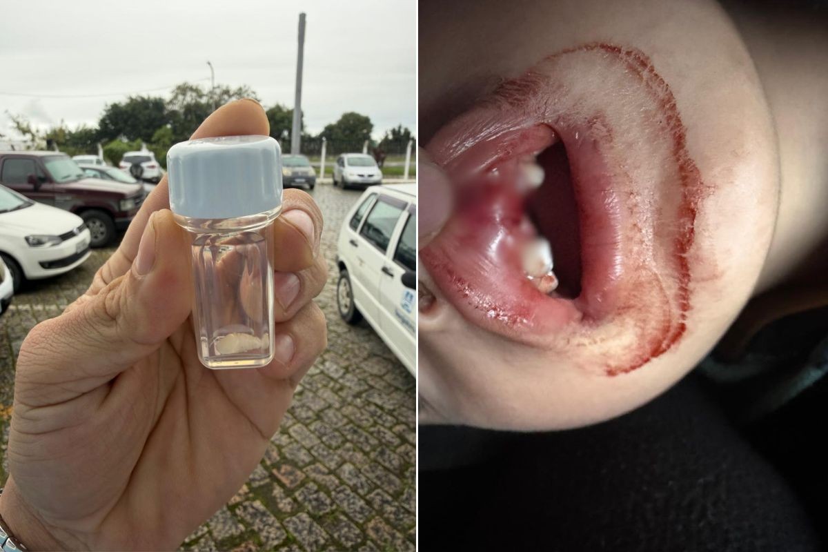 Menino perde dente em queda em creche de Registro (SP)